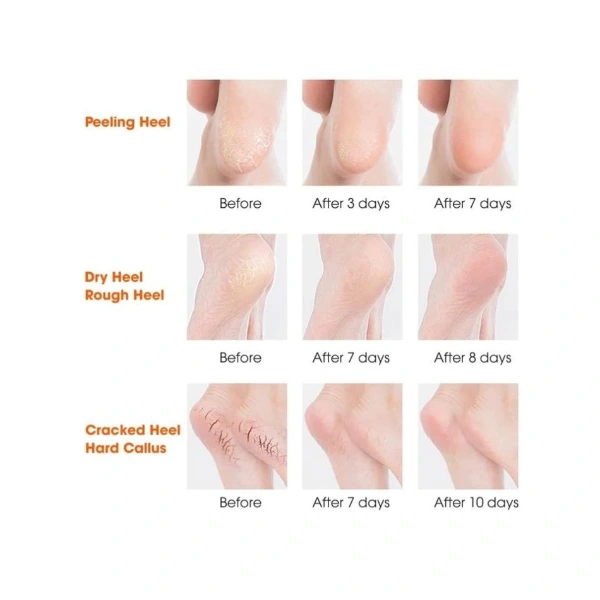 Silikon Topuk Nemlendirici Çorap ( Lisinya ) Silikon Topuk Nemlendirici Çorap ( Lisinya )